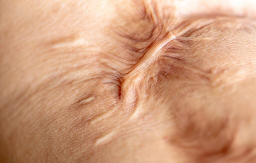 How Scar Tissue Is Causing Your Pain After Surgery — And What to Do About It